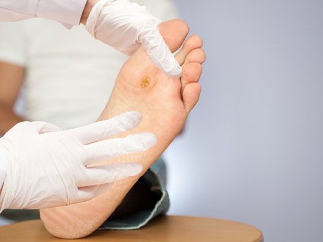 Ngâm chân bằng nước lá, nhiều bệnh nhân tiểu đường hoại tử chân phải cắt bỏ - Ảnh 1.