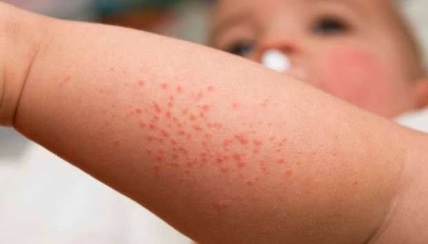 Nhiễm trùng huyết - biến chứng bệnh cúm có thể tử vong cần cảnh giác ở trẻ nhỏ - Ảnh 2.