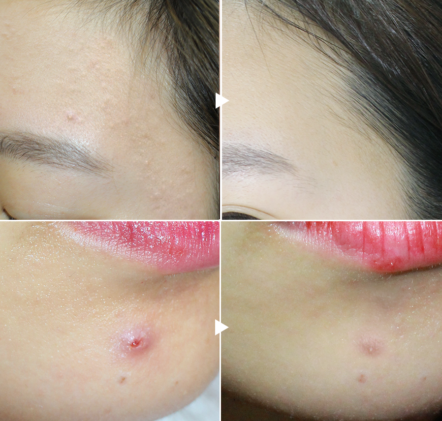 Nàng nào bị mụn thì đừng bỏ qua loại kem trị mụn của Nhật có giá chưa đến 200k này - Ảnh 4. Nàng nào bị mụn thì đừng bỏ qua loại kem trị mụn của Nhật có giá chưa đến 200k này - Ảnh 4.