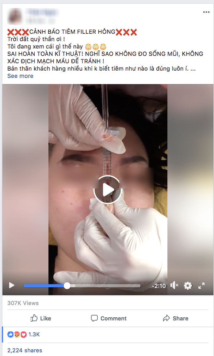 Clip tiêm Filler vào mũi sau đó bóp nặn thành dáng cao dài thẳng tắp đang được nhiều chị em chia sẻ vì... quá đáng sợ - Ảnh 1. Clip tiêm Filler vào mũi sau đó bóp nặn thành dáng cao dài thẳng tắp đang được nhiều chị em chia sẻ vì... quá đáng sợ - Ảnh 1.