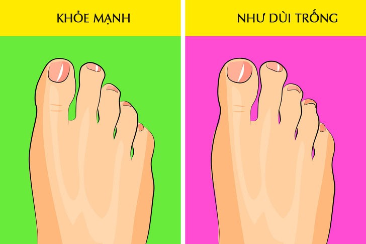 Thêm 5 dấu hiệu kì cục ở chân cảnh báo những rối loạn về sức khỏe không thể coi thường - Ảnh 2. Thêm 5 dấu hiệu kì cục ở chân cảnh báo những rối loạn về sức khỏe không thể coi thường - Ảnh 2.