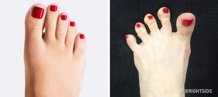 Thêm 5 dấu hiệu kì cục ở chân cảnh báo những rối loạn về sức khỏe không thể coi thường - Ảnh 5. Thêm 5 dấu hiệu kì cục ở chân cảnh báo những rối loạn về sức khỏe không thể coi thường - Ảnh 5.