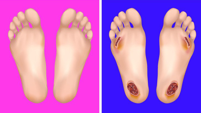 Nhìn ngay xuống bàn chân soi dấu hiệu bệnh tật cư trú trong người: Số 3 rất nguy hiểm! - Ảnh 3. Nhìn ngay xuống bàn chân soi dấu hiệu bệnh tật cư trú trong người: Số 3 rất nguy hiểm! - Ảnh 3.