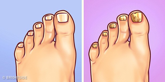 Nhìn ngay xuống bàn chân soi dấu hiệu bệnh tật cư trú trong người: Số 3 rất nguy hiểm! - Ảnh 5. Nhìn ngay xuống bàn chân soi dấu hiệu bệnh tật cư trú trong người: Số 3 rất nguy hiểm! - Ảnh 5.
