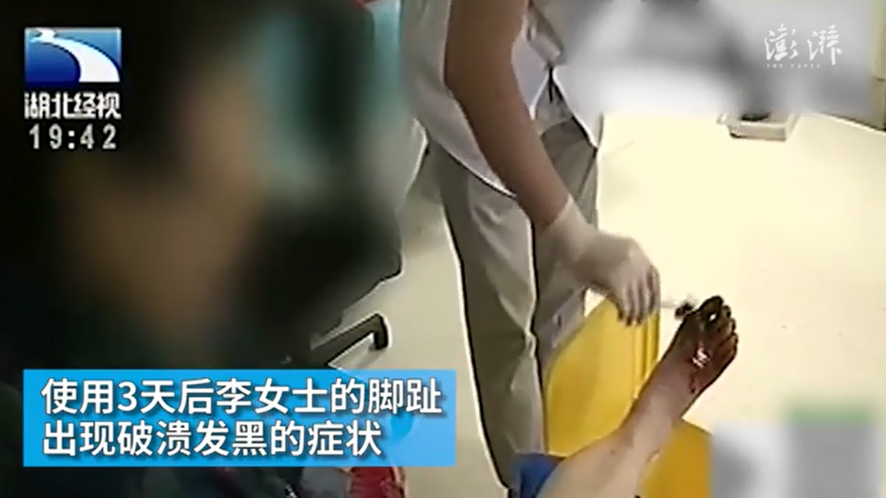 Con gái hiếu thảo thấy mẹ bị nấm liền mua thuốc khử trùng để ngâm chân, 3 ngày sau bà nhập viện vì suýt hoại tử - Ảnh 1. Con gái hiếu thảo thấy mẹ bị nấm liền mua thuốc khử trùng để ngâm chân, 3 ngày sau bà nhập viện vì suýt hoại tử - Ảnh 1.