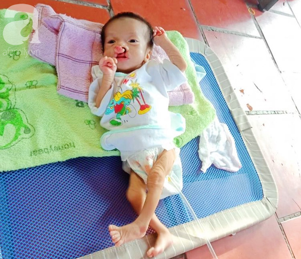 Xót cảnh bé trai 2 tháng tuổi bị suy dinh dưỡng, nặng chỉ 2 ký mà mẹ nghèo không đủ tiền để đưa lên Sài Gòn chữa bệnh 3
