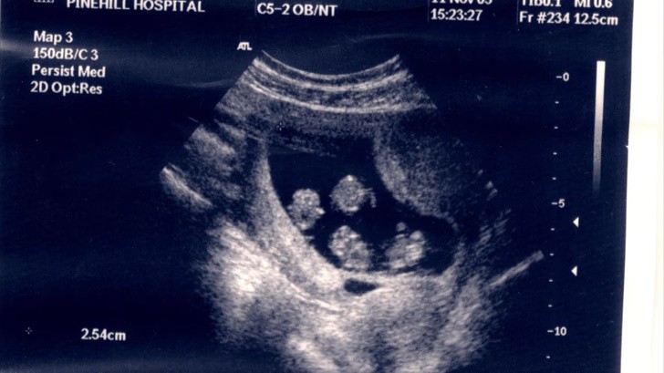 Lấy nhau m&atilde;i kh&ocirc;ng c&oacute; con, vợ bất ngờ mang thai v&agrave; kết quả si&ecirc;u &acirc;m ngo&agrave;i sức tưởng tượng của b&aacute;c sĩ - Ảnh 2.