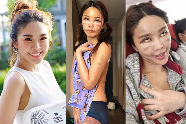 Hot girl Th&aacute;i c&ocirc;ng khai loạt h&igrave;nh thẩm mỹ sau 20 ng&agrave;y c&ugrave;ng hội bạn th&acirc;n khiến nhiều người bất ngờ  - Ảnh 14.