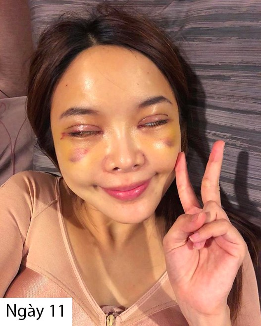 Hot girl Th&aacute;i c&ocirc;ng khai loạt h&igrave;nh thẩm mỹ sau 20 ng&agrave;y c&ugrave;ng hội bạn th&acirc;n khiến nhiều người bất ngờ  - Ảnh 8.