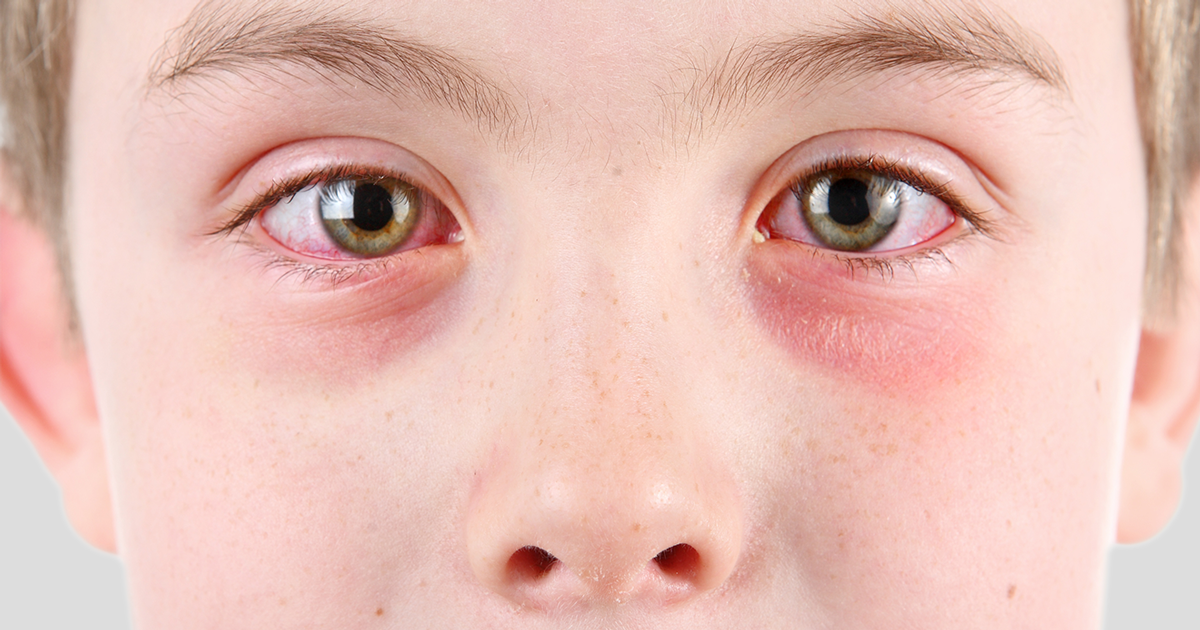 Tới gặp bác sĩ ngay nếu bạn bị đau mắt kèm theo những triệu chứng này - Ảnh 1.