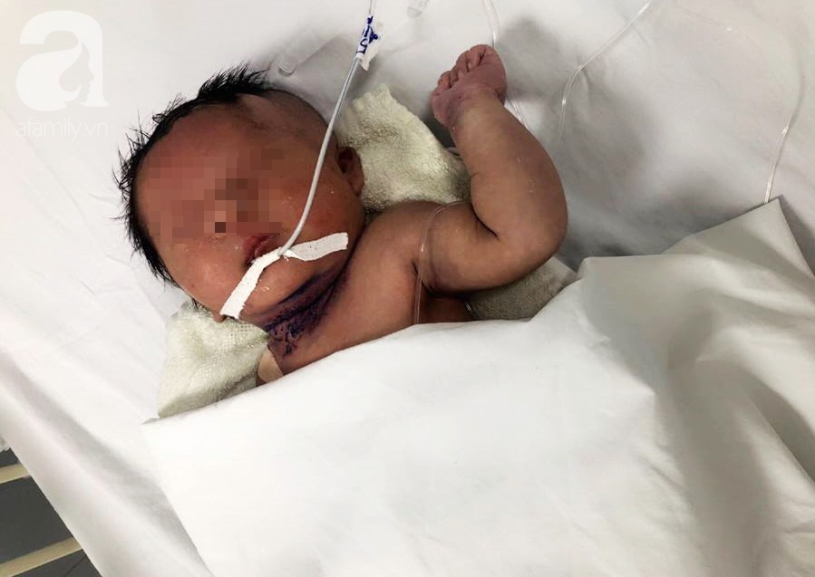 TP.HCM: B&eacute; trai 5 ng&agrave;y tuổi đang khỏe mạnh bỗng ọc m&aacute;u, suy h&ocirc; hấp v&agrave; h&ocirc;n m&ecirc; v&igrave; căn bệnh rất hiểm - Ảnh 3.