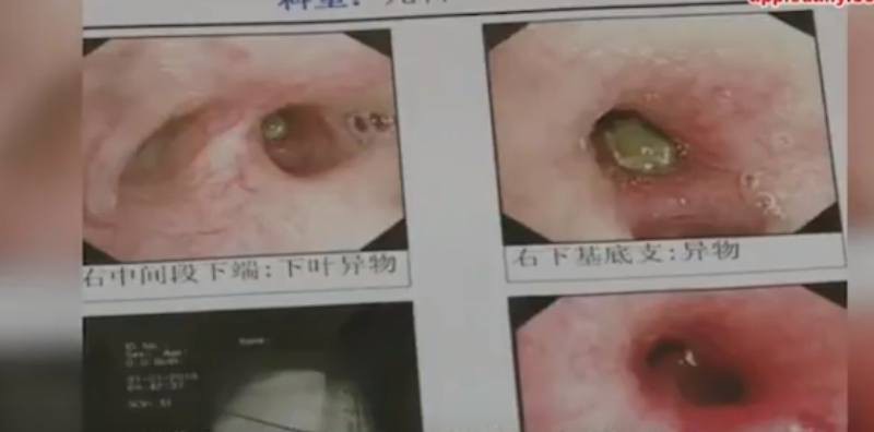 Cho con uống trà sữa trân châu, mẹ hoảng loạn khi con ho và sốt liên tục, nửa năm sau phát hiện sự thật kinh hoàng - Ảnh 2. Cho con uống trà sữa trân châu, mẹ hoảng loạn khi con ho và sốt liên tục, nửa năm sau phát hiện sự thật kinh hoàng - Ảnh 2.