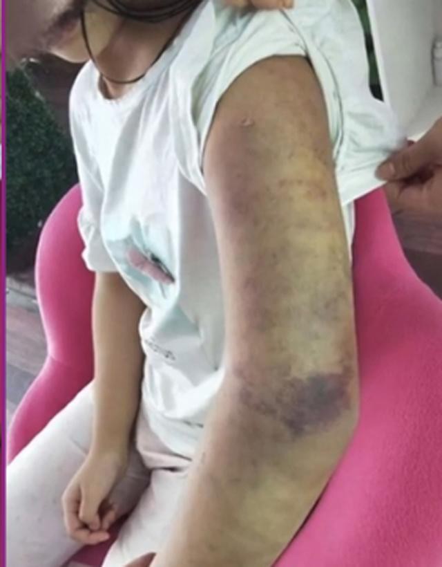 Mẹ kế h&agrave;nh hạ con g&aacute;i ri&ecirc;ng của chồng th&acirc;n t&agrave;n ma dại, cơ thể rớm m&aacute;u, người bố nhẫn t&acirc;m n&oacute;i đ&aacute;nh thế l&agrave; đ&uacute;ng - Ảnh 3.