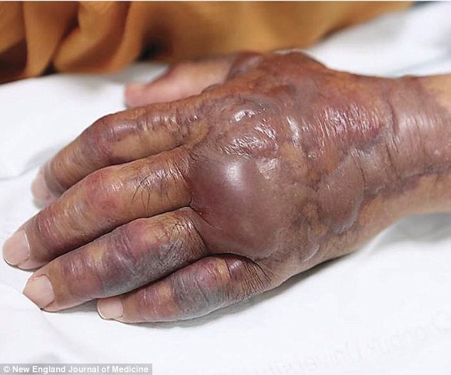 Bị cắt cụt tay chỉ vì ăn món khoái khẩu này: Chuyên gia cảnh báo một thói quen ăn uống dễ dẫn đến cái kết đắng! - Ảnh 2. Bị cắt cụt tay chỉ vì ăn món khoái khẩu này: Chuyên gia cảnh báo một thói quen ăn uống dễ dẫn đến cái kết đắng! - Ảnh 2.