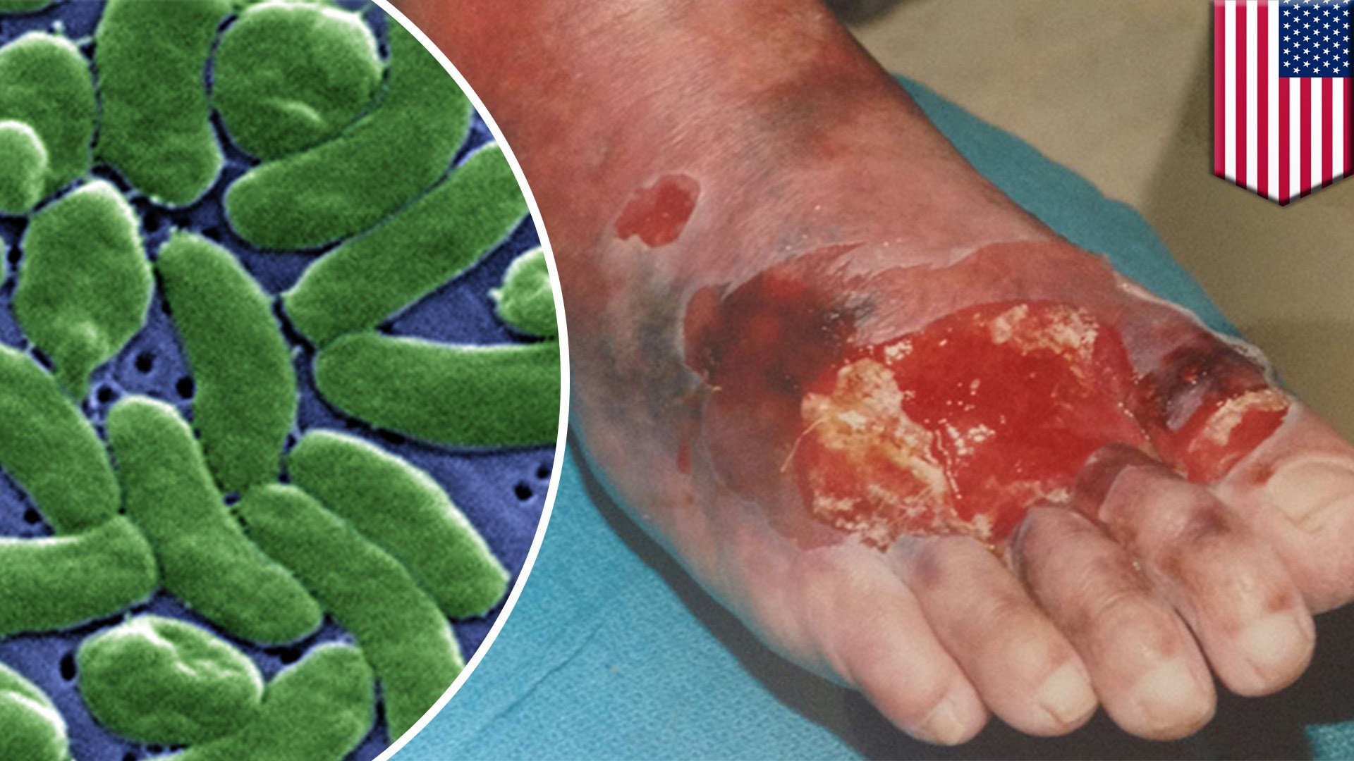 Bị cắt cụt tay chỉ vì ăn món khoái khẩu này: Chuyên gia cảnh báo một thói quen ăn uống dễ dẫn đến cái kết đắng! - Ảnh 4. Bị cắt cụt tay chỉ vì ăn món khoái khẩu này: Chuyên gia cảnh báo một thói quen ăn uống dễ dẫn đến cái kết đắng! - Ảnh 4.