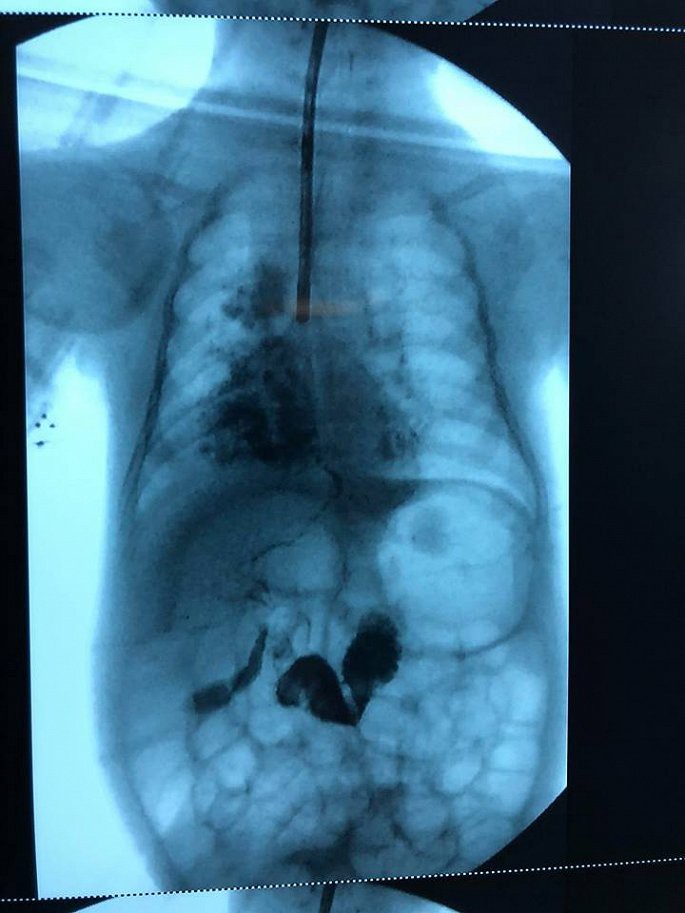 B&eacute; g&aacute;i 2 th&aacute;ng tuổi mắc bệnh lạ chỉ 40 người tr&ecirc;n thế giới gặp phải - Ảnh 1.