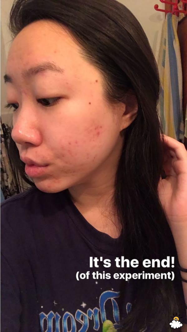 Thoa dầu dừa lên da trong 1 tuần để chữa sẹo mụn, cô nàng này đã nhận được kết quả đáng thất vọng - Ảnh 8.