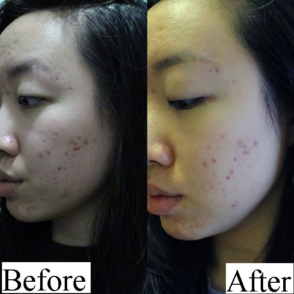 Thoa dầu dừa lên da trong 1 tuần để chữa sẹo mụn, cô nàng này đã nhận được kết quả đáng thất vọng - Ảnh 9.