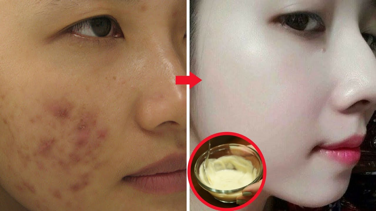 Mặt biến dạng sau bôi kem trộn đáng sợ như này nhưng nhiều người ham hố, chuyên gia khuyên: Đừng để đẹp tức thì rồi hóa quỷ! - Ảnh 3. Mặt biến dạng sau bôi kem trộn đáng sợ như này nhưng nhiều người ham hố, chuyên gia khuyên: Đừng để đẹp tức thì rồi hóa quỷ! - Ảnh 3.