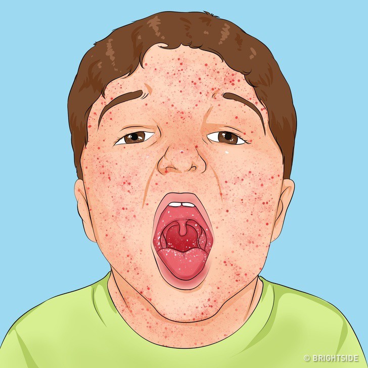 Có những căn bệnh nguy hiểm ở trẻ ẩn sau những triệu chứng tưởng là cảm sốt thông thường - Ảnh 9. Có những căn bệnh nguy hiểm ở trẻ ẩn sau những triệu chứng tưởng là cảm sốt thông thường - Ảnh 9.