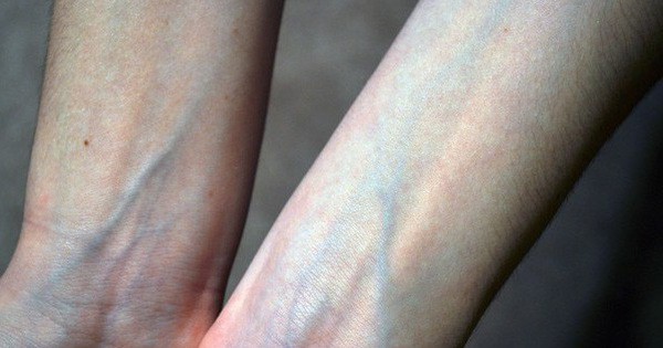 Nổi g&acirc;n xanh tr&ecirc;n cơ thể, bệnh g&igrave;? - Ảnh 1.