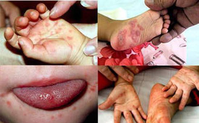 Đã có 6 trẻ tử vong do tay chân miệng: Dấu hiệu cảnh báo bạn phải đưa con đi cấp cứu ngay - Ảnh 2. Đã có 6 trẻ tử vong do tay chân miệng: Dấu hiệu cảnh báo bạn phải đưa con đi cấp cứu ngay - Ảnh 2.