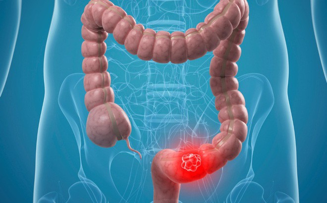 Chàng trai 22 tuổi bị ung thư ruột chỉ vì chữa táo bón theo cách nhiều người đang làm - Ảnh 2. Chàng trai 22 tuổi bị ung thư ruột chỉ vì chữa táo bón theo cách nhiều người đang làm - Ảnh 2.