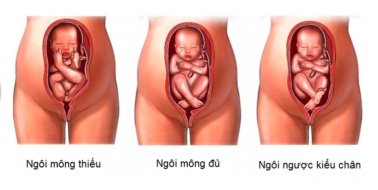 Những điều mẹ bầu cần biết khi được chẩn đoán có ngôi thai ngược - Ảnh 1. Những điều mẹ bầu cần biết khi được chẩn đoán có ngôi thai ngược - Ảnh 1.
