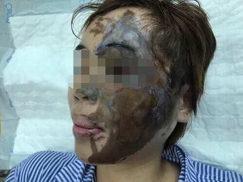 Lần đầu ti&ecirc;n tạo h&igrave;nh gương mặt bỏng axit trong 1 th&igrave; bằng vi phẫu - Ảnh 1.