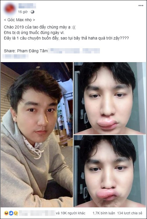 Kể khổ bị dị ứng thuốc, m&ocirc;i sưng tều đ&uacute;ng ng&agrave;y đầu năm 2019, nam thanh ni&ecirc;n lại được ch&uacute; &yacute; rần rần bởi nhan sắc thực sự ph&iacute;a sau - Ảnh 1.