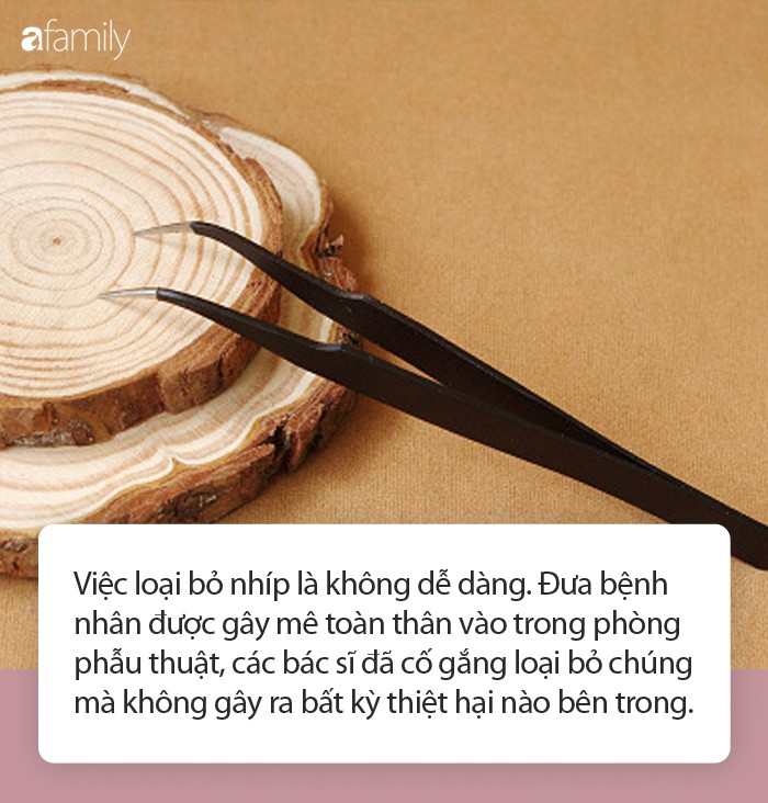 Kinh hãi nam thanh niên nhét cặp nhíp vào niệu đạo 4 năm trời mà không hay biết - Ảnh 1. Kinh hãi nam thanh niên nhét cặp nhíp vào niệu đạo 4 năm trời mà không hay biết - Ảnh 1.