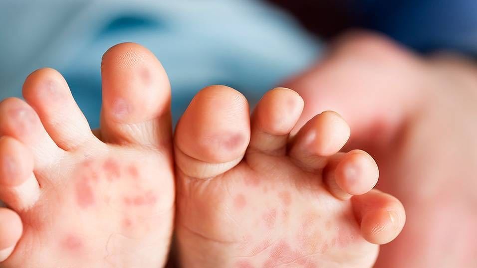 Cảnh báo bệnh tay chân miệng vào mùa: Bệnh tay chân miệng lây qua đường nào? - Ảnh 2. Cảnh báo bệnh tay chân miệng vào mùa: Bệnh tay chân miệng lây qua đường nào? - Ảnh 2.