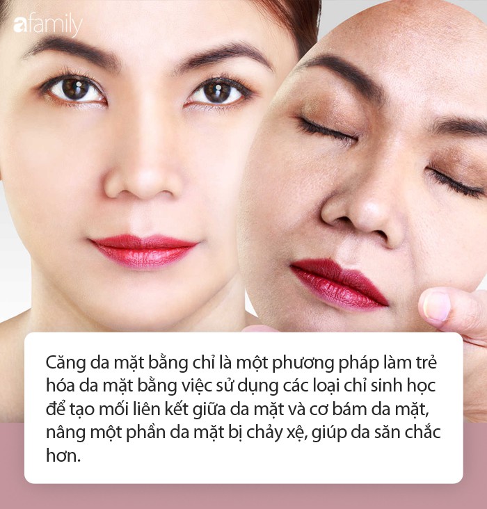 Trong các phương pháp căng da mặt, căng da mặt bằng chỉ dù nhẹ nhàng hơn cả cũng có rủi ro biến chứng đi kèm! - Ảnh 3. Trong các phương pháp căng da mặt, căng da mặt bằng chỉ dù nhẹ nhàng hơn cả cũng có rủi ro biến chứng đi kèm! - Ảnh 3.
