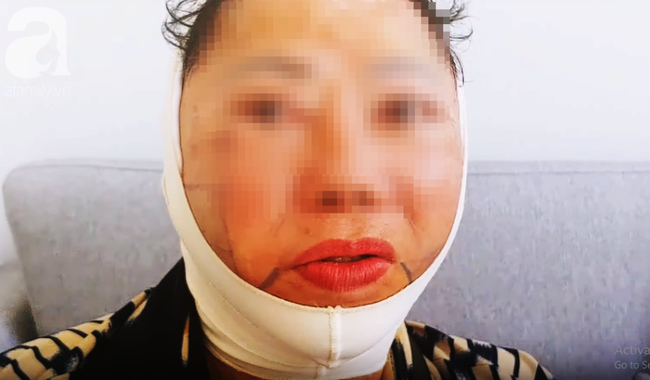 Trong các phương pháp căng da mặt, căng da mặt bằng chỉ dù nhẹ nhàng hơn cả cũng có rủi ro biến chứng đi kèm! - Ảnh 1. Trong các phương pháp căng da mặt, căng da mặt bằng chỉ dù nhẹ nhàng hơn cả cũng có rủi ro biến chứng đi kèm! - Ảnh 1.