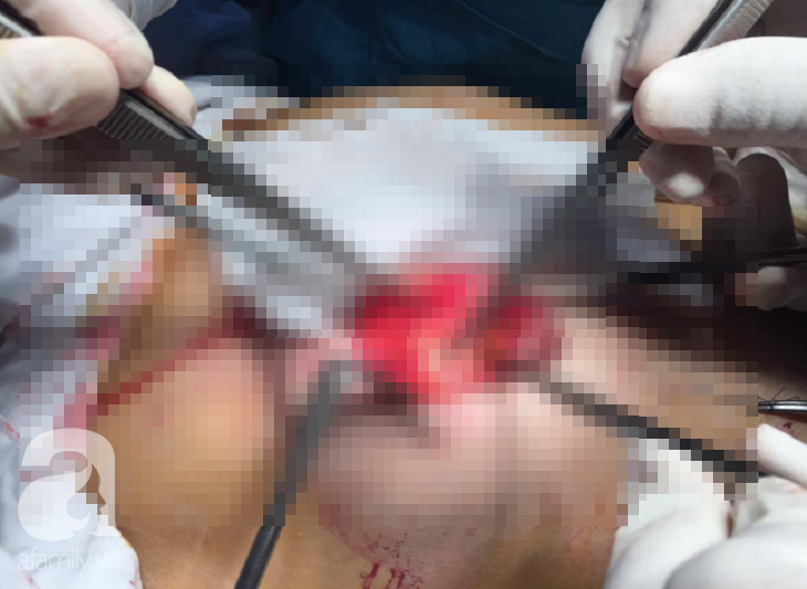 Từ hai vụ tử vong khi nâng ngực, căng da mặt: Bác sĩ tiết lộ những biến chứng thẩm mỹ có thể xảy ra - Ảnh 4. Từ hai vụ tử vong khi nâng ngực, căng da mặt: Bác sĩ tiết lộ những biến chứng thẩm mỹ có thể xảy ra - Ảnh 4.