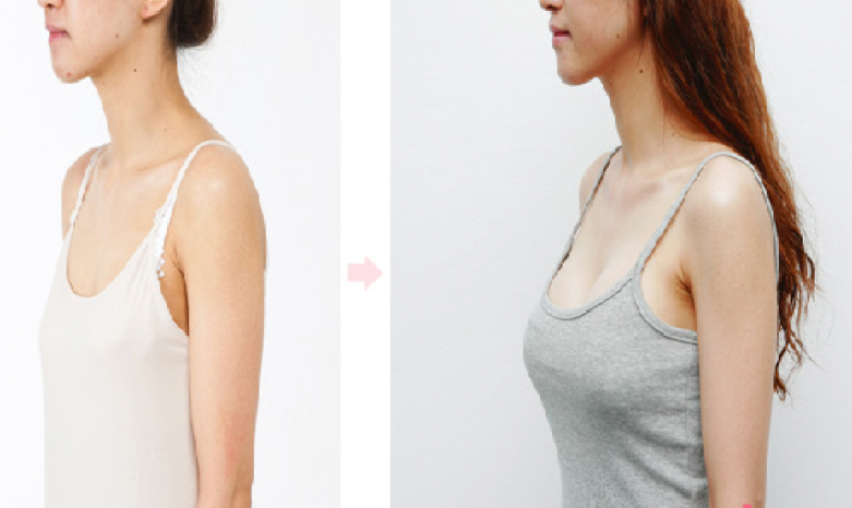 Ngày càng nhiều người tử vong do phẫu thuật nâng ngực: Đây là nguyên tắc sống còn trước khi bạn quyết định làm! - Ảnh 7. Ngày càng nhiều người tử vong do phẫu thuật nâng ngực: Đây là nguyên tắc sống còn trước khi bạn quyết định làm! - Ảnh 7.