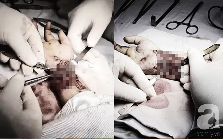 Thương tâm: Trượt chân trong nhà tắm, bé trai 6 tuổi bị mảnh gạch vỡ cắt gần đứt lìa cổ tay - Ảnh 1. Thương tâm: Trượt chân trong nhà tắm, bé trai 6 tuổi bị mảnh gạch vỡ cắt gần đứt lìa cổ tay - Ảnh 1.