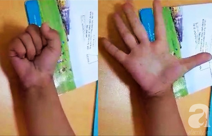 Thương tâm: Trượt chân trong nhà tắm, bé trai 6 tuổi bị mảnh gạch vỡ cắt gần đứt lìa cổ tay - Ảnh 3. Thương tâm: Trượt chân trong nhà tắm, bé trai 6 tuổi bị mảnh gạch vỡ cắt gần đứt lìa cổ tay - Ảnh 3.