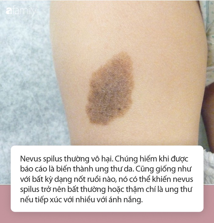 Từ khu vực ung thư da nhỏ xíu, người đàn ông buộc phải lọc da chân ghép lên gáy cổ mới cứu được mạng mình - Ảnh 4. Từ khu vực ung thư da nhỏ xíu, người đàn ông buộc phải lọc da chân ghép lên gáy cổ mới cứu được mạng mình - Ảnh 4.