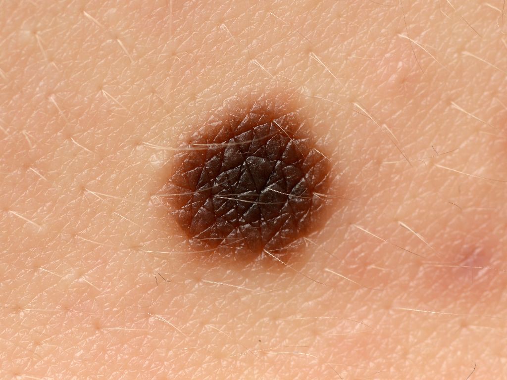 Từ khu vực ung thư da nhỏ xíu, người đàn ông buộc phải lọc da chân ghép lên gáy cổ mới cứu được mạng mình - Ảnh 6. Từ khu vực ung thư da nhỏ xíu, người đàn ông buộc phải lọc da chân ghép lên gáy cổ mới cứu được mạng mình - Ảnh 6.