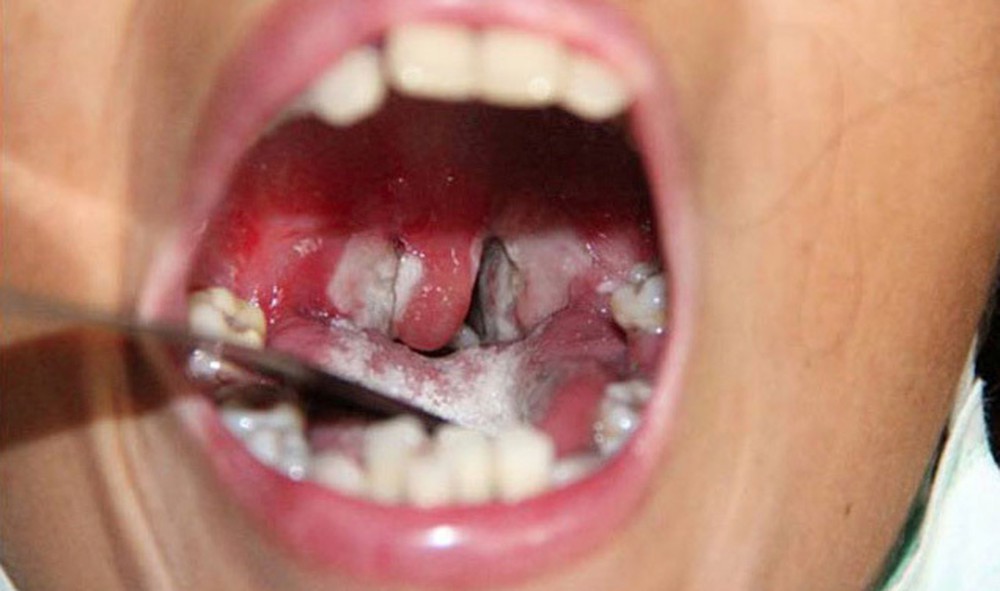 Bệnh bạch hầu có thể gây liệt cơ, viêm cơ tim, tử vong trong 6 ngày: Đừng bỏ qua triệu chứng bệnh bạch hầu - Ảnh 1. Bệnh bạch hầu có thể gây liệt cơ, viêm cơ tim, tử vong trong 6 ngày: Đừng bỏ qua triệu chứng bệnh bạch hầu - Ảnh 1.