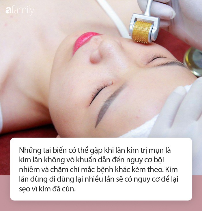 Lăn kim trị mụn: Những lưu ý quan trọng không thể bỏ qua trước khi làm từ bác sĩ da liễu - Ảnh 5. Lăn kim trị mụn: Những lưu ý quan trọng không thể bỏ qua trước khi làm từ bác sĩ da liễu - Ảnh 5.
