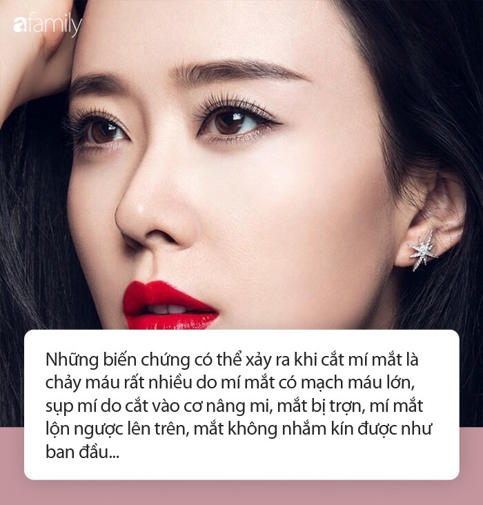 Nghi vấn Vân Tokyo cắt mí mắt cho khách bị hỏng: Đây là những điều bạn cần nhớ trước khi làm - Ảnh 5. Nghi vấn Vân Tokyo cắt mí mắt cho khách bị hỏng: Đây là những điều bạn cần nhớ trước khi làm - Ảnh 5.