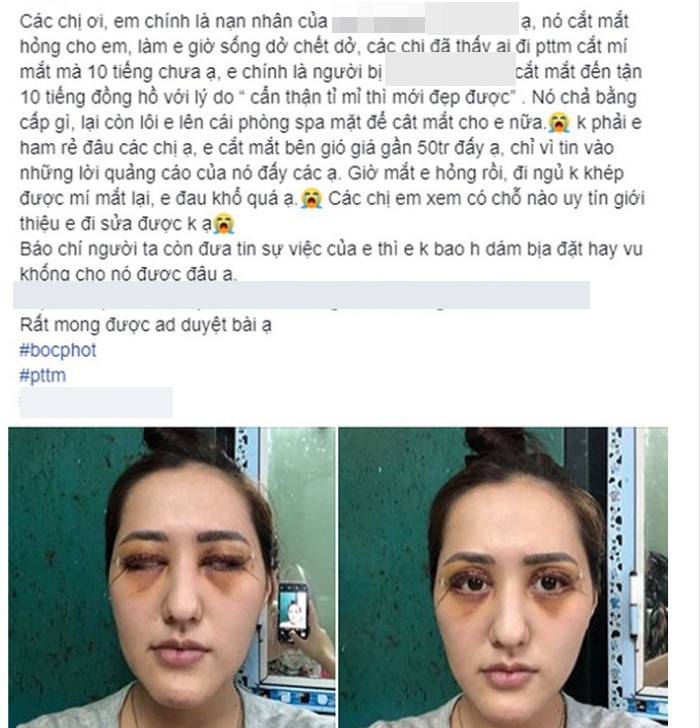 Người phụ nữ kêu cứu sau khi đi cắt mí mắt bị hỏng: Đây là những điều bạn cần nhớ trước khi làm phẫu thuật này - Ảnh 1. Người phụ nữ kêu cứu sau khi đi cắt mí mắt bị hỏng: Đây là những điều bạn cần nhớ trước khi làm phẫu thuật này - Ảnh 1.