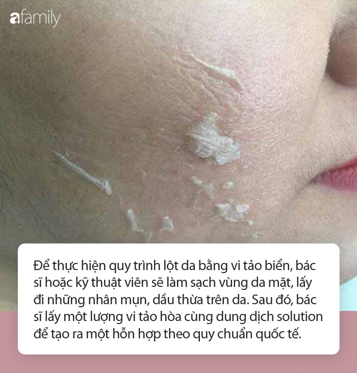 Lột da bằng vi tảo biển: Chuyên gia nhận định thế nào về phương pháp làm đẹp này? - Ảnh 4. Lột da bằng vi tảo biển: Chuyên gia nhận định thế nào về phương pháp làm đẹp này? - Ảnh 4.