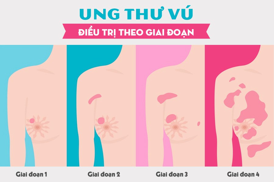 Mang bầu 5 tháng thì phát hiện bị ung thư vú giai đoạn 3, người mẹ này chấp nhận mổ và hóa trị ngay trong thai kì để cứu 2 mẹ con - Ảnh 6. Mang bầu 5 tháng thì phát hiện bị ung thư vú giai đoạn 3, người mẹ này chấp nhận mổ và hóa trị ngay trong thai kì để cứu 2 mẹ con - Ảnh 6.