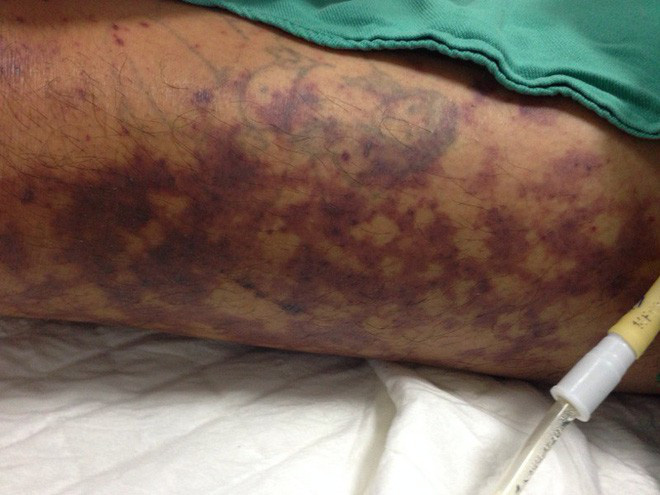 Chưa đến Tết đã có người suýt chết do liên cầu khuẩn lợn: Chuyên gia lưu ý điều quan trọng khi mua thịt lợn - Ảnh 3. Chưa đến Tết đã có người suýt chết do liên cầu khuẩn lợn: Chuyên gia lưu ý điều quan trọng khi mua thịt lợn - Ảnh 3.