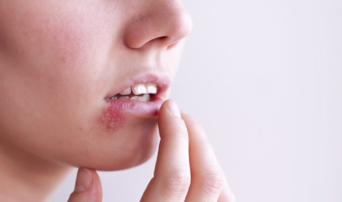 Nhầm tưởng về bệnh herpes không ít phụ nữ mắc phải - Ảnh 1. Nhầm tưởng về bệnh herpes không ít phụ nữ mắc phải - Ảnh 1.