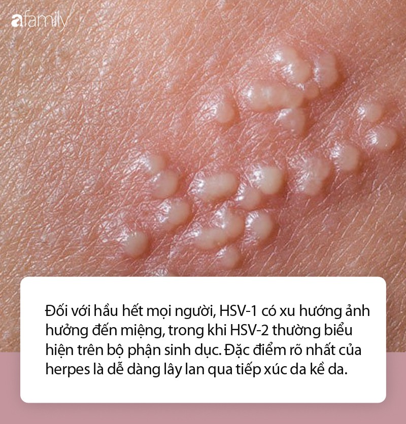Nhầm tưởng về bệnh herpes không ít phụ nữ mắc phải - Ảnh 2. Nhầm tưởng về bệnh herpes không ít phụ nữ mắc phải - Ảnh 2.