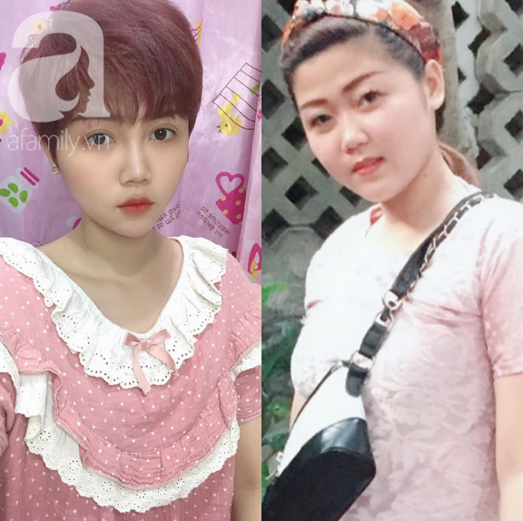 Mẹ một con kể chuyện phẫu thuật thẩm mỹ đau hơn… đau đẻ, lột xác sau 9 lần “dao kéo” với vỏn vẹn 30 triệu đồng - Ảnh 1. Mẹ một con kể chuyện phẫu thuật thẩm mỹ đau hơn… đau đẻ, lột xác sau 9 lần “dao kéo” với vỏn vẹn 30 triệu đồng - Ảnh 1.